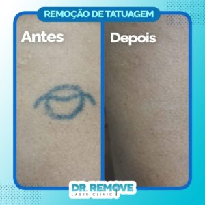 Antes e Depois