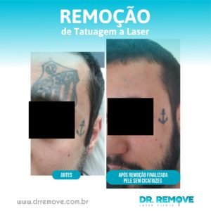 Antes e Depois