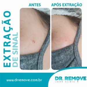 Antes e Depois