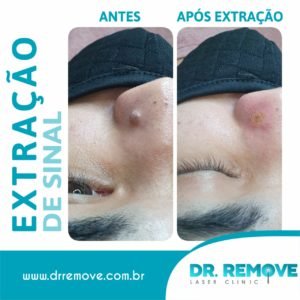 Antes e Depois